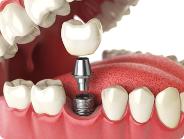 Dental Implants