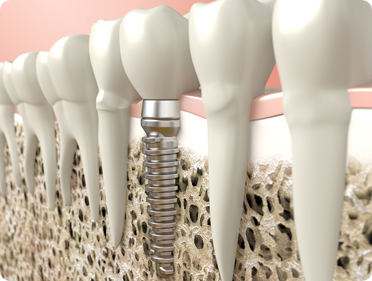 Pre-Implant Bone Augmentation